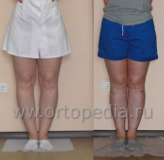 Исправление деформации ног в Центре антропометрической косметологии и коррекции